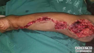 車禍傷后10小時，奔波500里，原本要截肢的腿在這保住了！