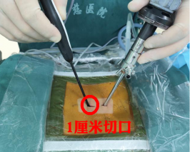 脊柱雙通道內(nèi)鏡“出手”，1cm微創(chuàng)切口解決腰椎間盤(pán)突出癥